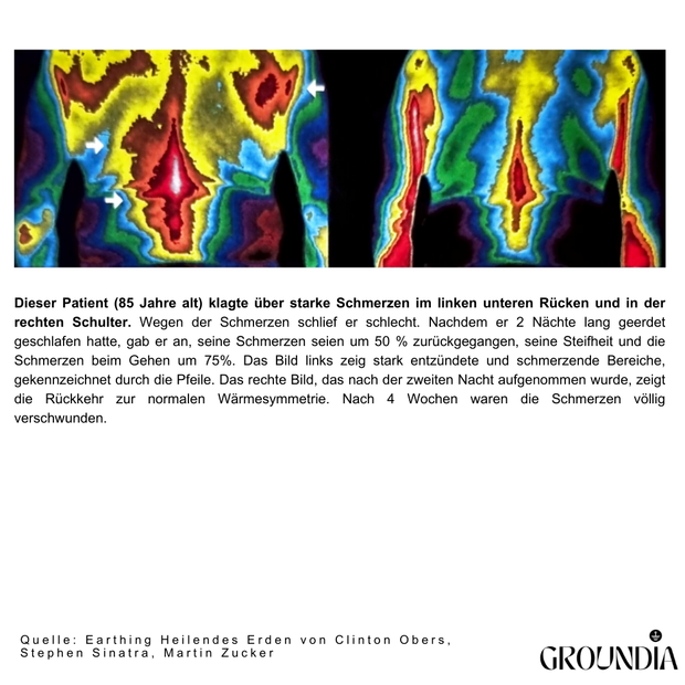 Vorher-Nachher Vergleich mit Thermografie: Wirkung des Erdungslakens auf die Körpertemperatur

